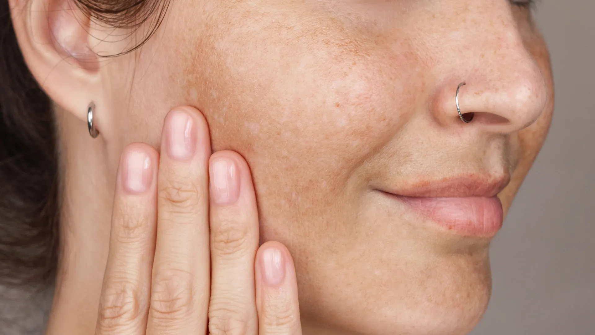 Acne & Marks