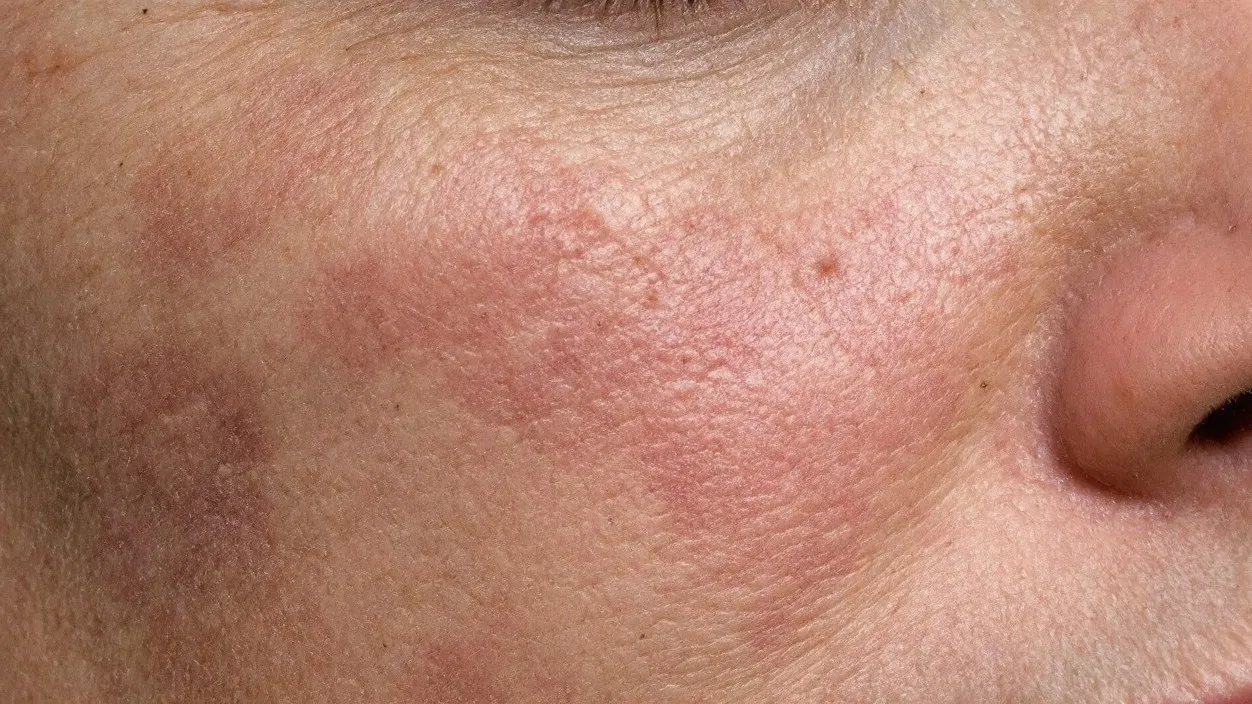 Dull Skin